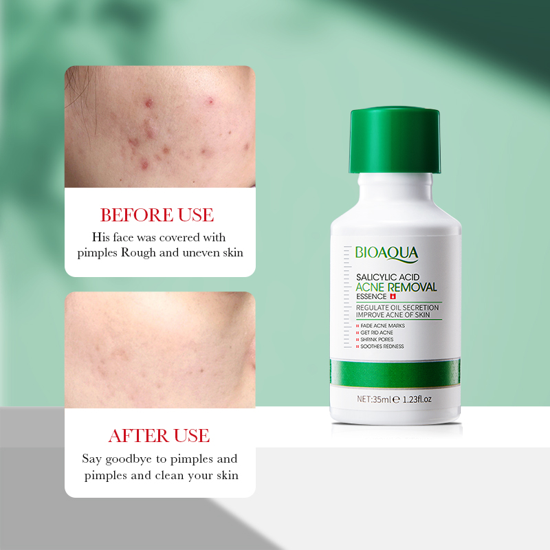 35ml BIOAOUA Salicylic Acid An - огляд і ціна Tranexamic Acid Serum